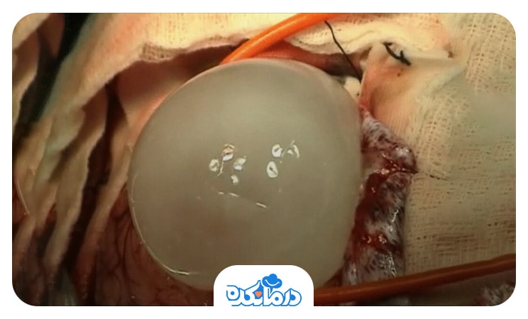 پاورپوینت کیست هیداتیک