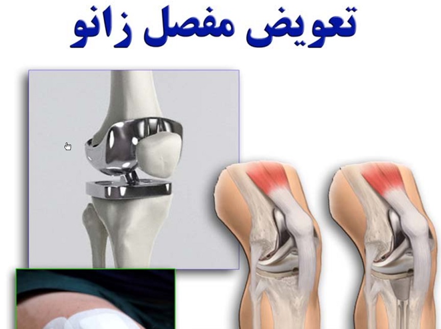 دانلود راهنمای بیماران برای تعویض مفصل زانو